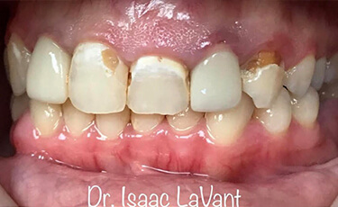 Can You Eat with Invisalign