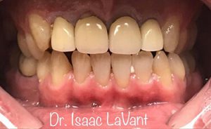 How to Stop Grinding Teeth in Sleep Naturally