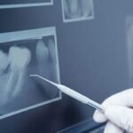 500x332_0003_Gloved-hand-holding-dental-tool-to-teeth-x-ray-300x199-1-150x150 Image Text: 500x332_0003_Gloved-hand-holding-dental-tool-to-teeth-x-ray-300x199-1-150x150